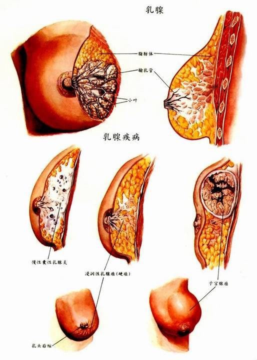 乳腺癌术后并发症