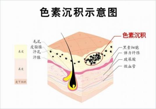 皮肤色素沉着