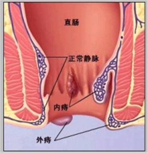 炎性外痔疮