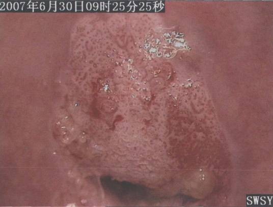 子宫颈白斑