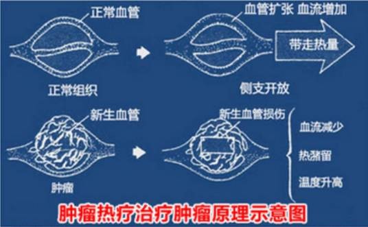 肿瘤热疗