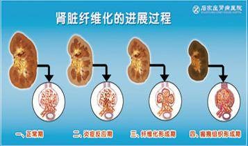 肾脏纤维化