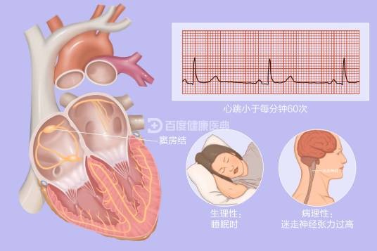 窦性心动过缓