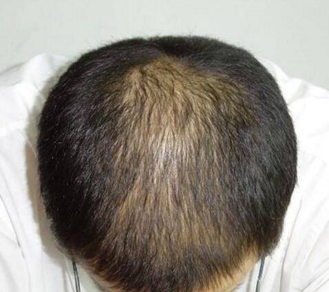 肾虚型脱发