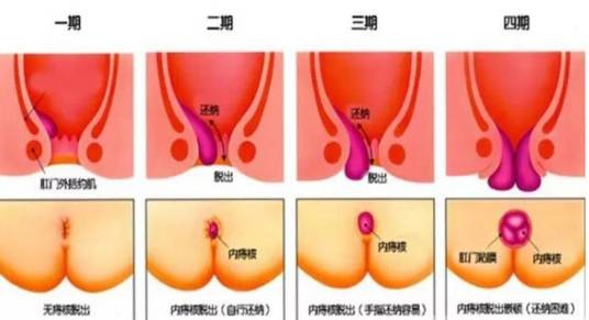 内痔脱出