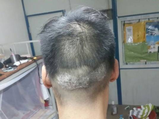 头皮型银屑病