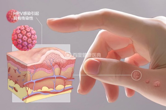 疣(人类乳头瘤病毒引起的皮肤表面赘生物)