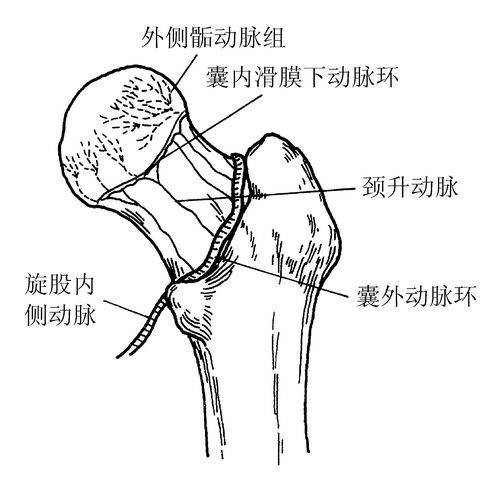 缺血型股骨头坏死