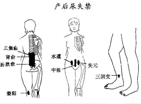 产后尿失禁