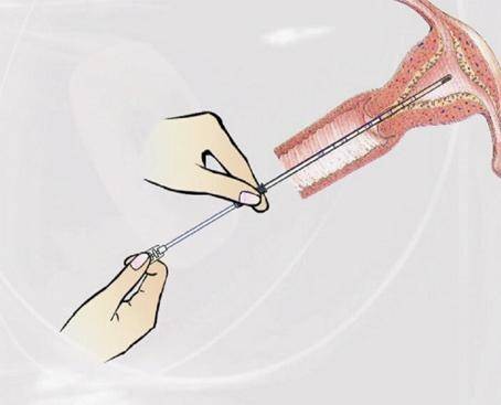 诊断性刮宫