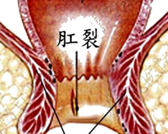 肛裂出血