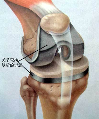 人工全膝关节置换术（手术名称）