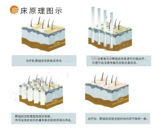OS像素激光