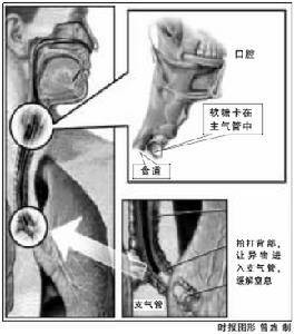 急性缺氧性脑病