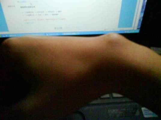 手腕腱鞘囊肿
