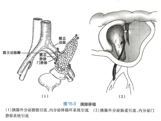 胰腺移植