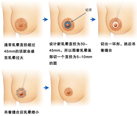 乳晕缩小