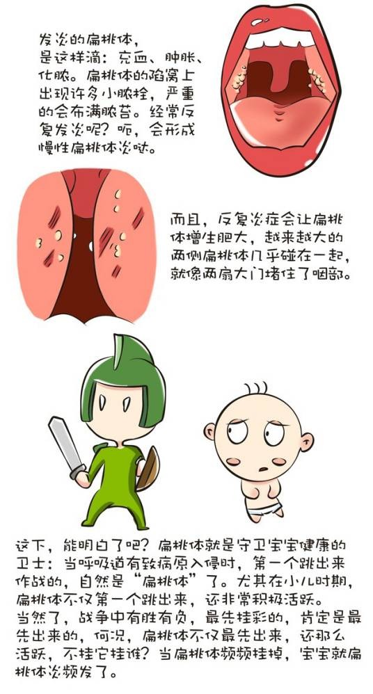 儿童扁桃体炎