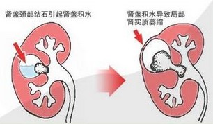 胎儿双肾积水