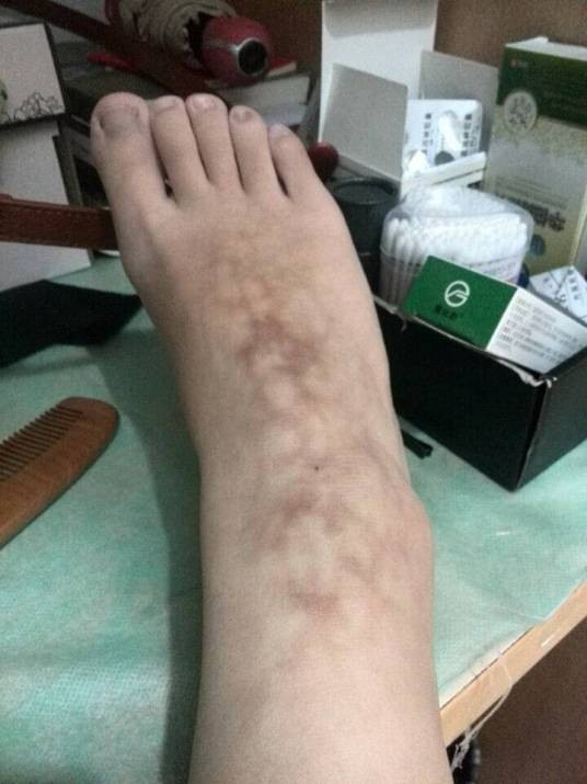 毛细血管破裂