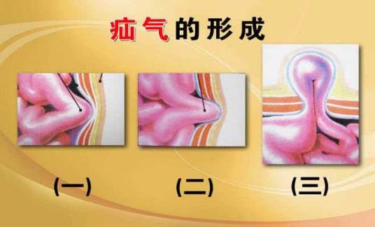 老年疝气