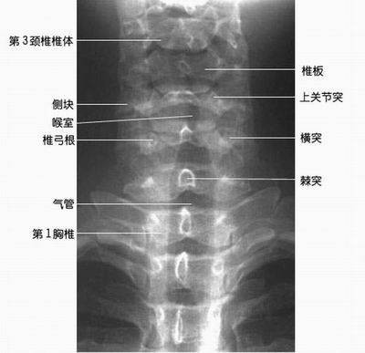 颈椎炎