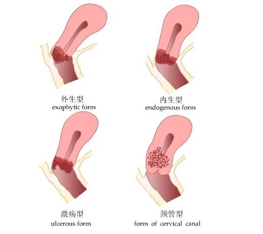 接触性出血