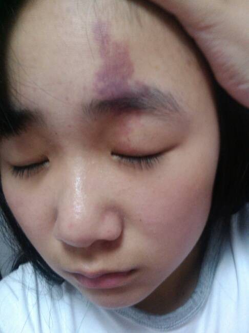 去胎记