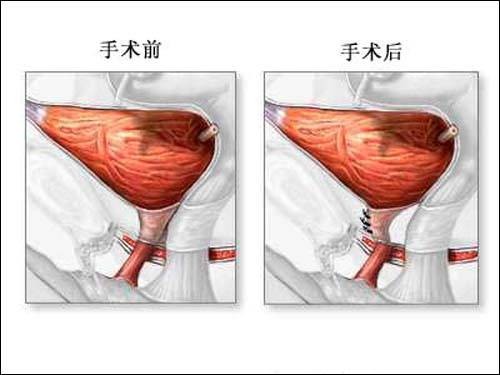 阴道前壁脱垂