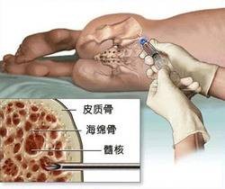胶原酶介入溶解术