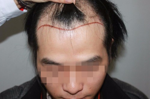 发际线调整