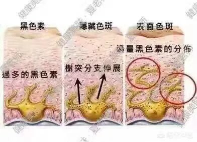激光祛斑真的有效吗?