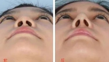 整形隆鼻哪好