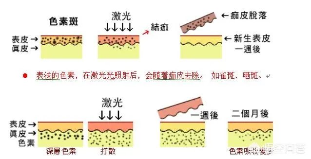 激光祛斑真的有效吗?