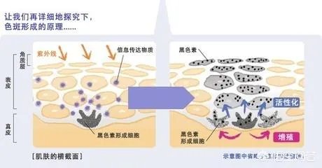 激光祛斑真的有效吗?