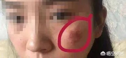 激光祛斑真的有效吗?