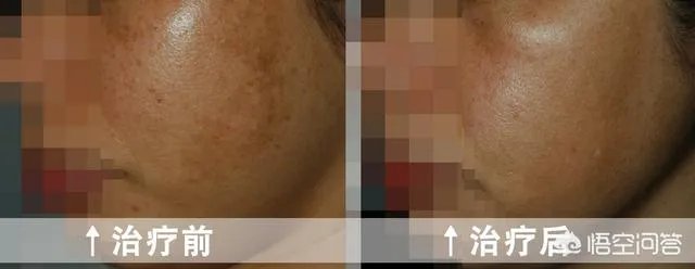 激光祛斑真的有效吗?
