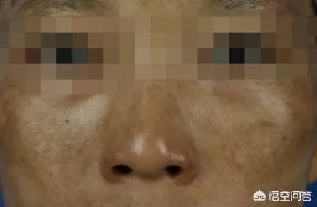激光祛斑真的有效吗?