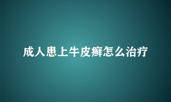 成人患上牛皮癣怎么治疗