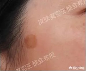 如何判断是不是得了扁平疣?