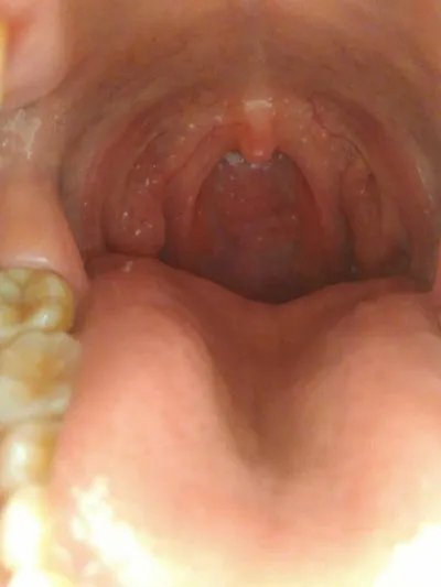 舌癌的早期症状?