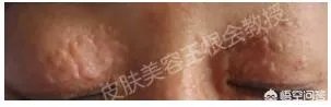 如何判断是不是得了扁平疣?