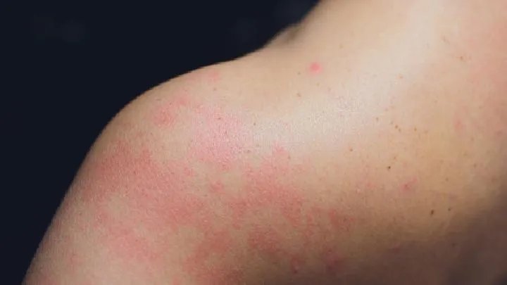 头皮毛囊炎的危害是什么呢