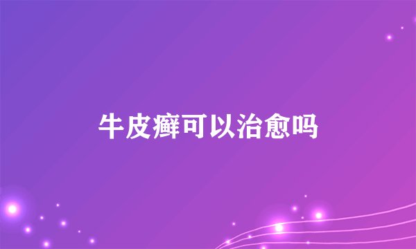 牛皮癣可以治愈吗