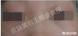 如何判断是不是得了扁平疣?