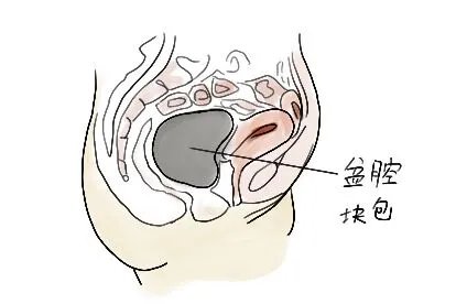 盆腔包块图片
