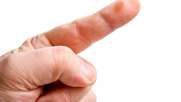 烫伤怎么办