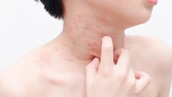 湿疹传染吗