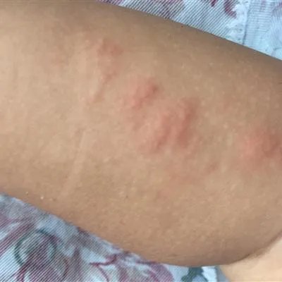 药物性皮炎怎么办?