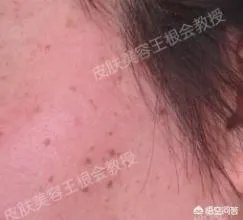 如何判断是不是得了扁平疣?
